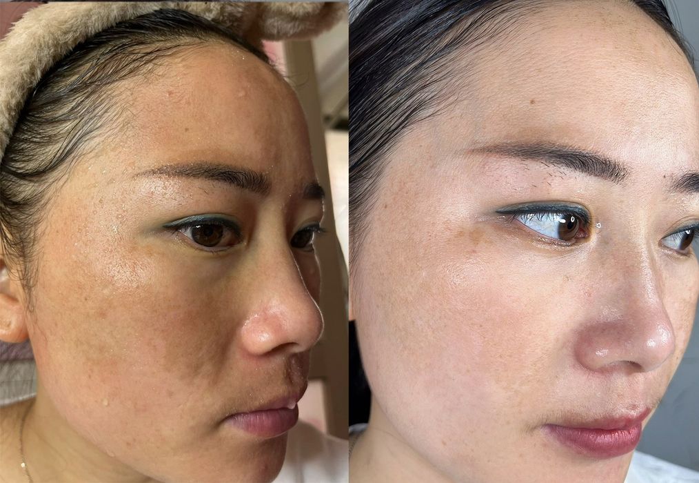 Trước và sau khi dùng liệu trình